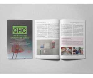 Revista QHC Urolitiasis de oxalato de calcio